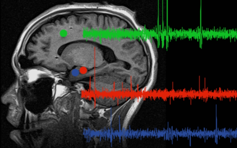 An MRI of a brain