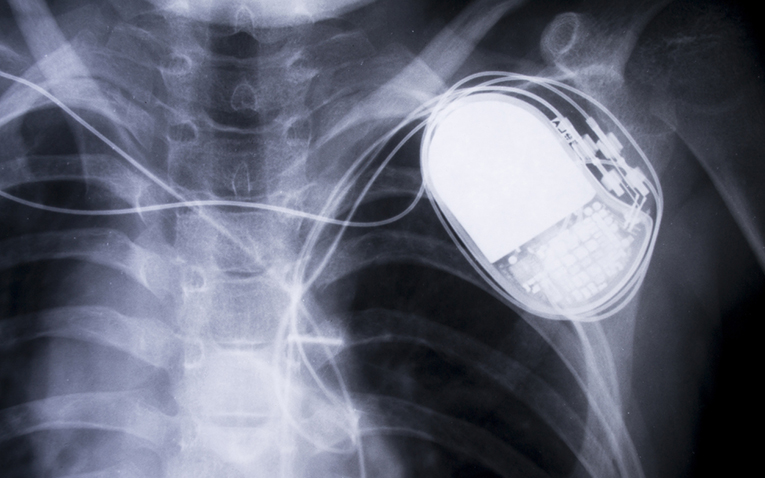 X-ray of a chest with a pacemaker.