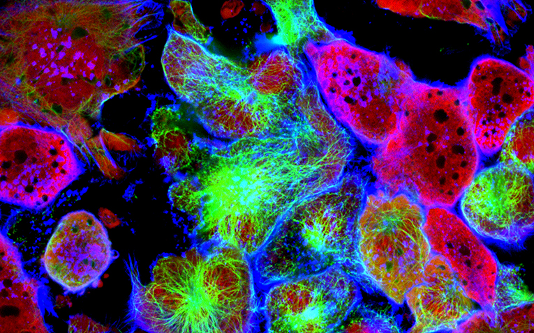 Tumor cells under microscope labeled with fluorescent molecules