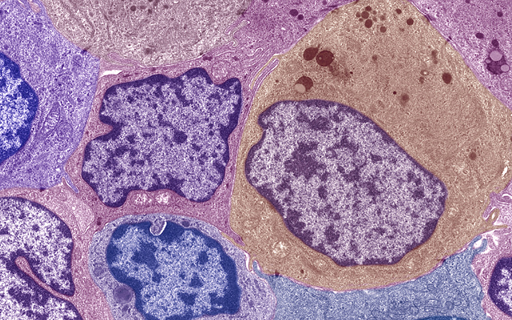 Triple-negative breast cancer scan.