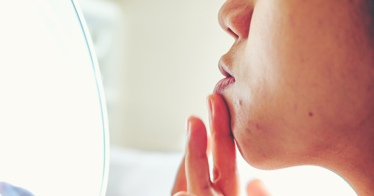 Don't Mistake These Skin Conditions for Acne | Cedars-Sinai