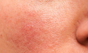 4 Common Skin Conditions Mistaken For Acne Cedars Sinai