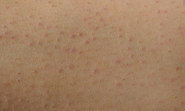 4 Common Skin Conditions Mistaken for Acne | Cedars-Sinai