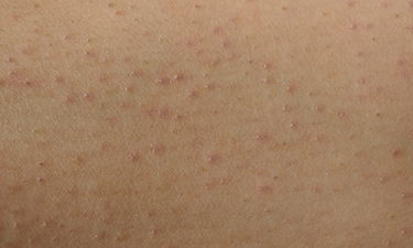 4 Common Skin Conditions Mistaken For Acne Cedars Sinai