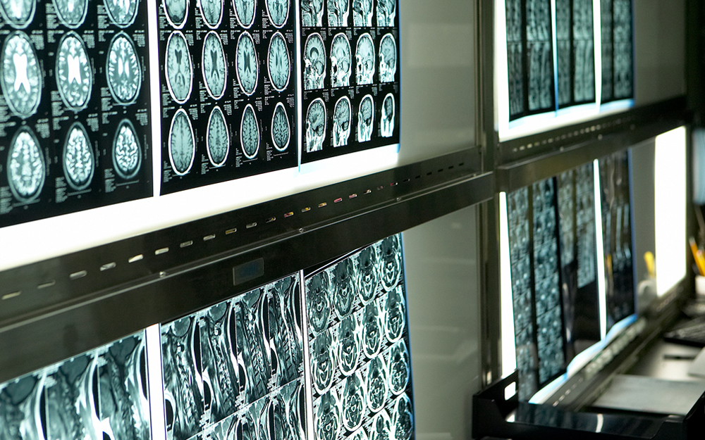 MRI brain scans to detect Multiple sclerosis (MS).