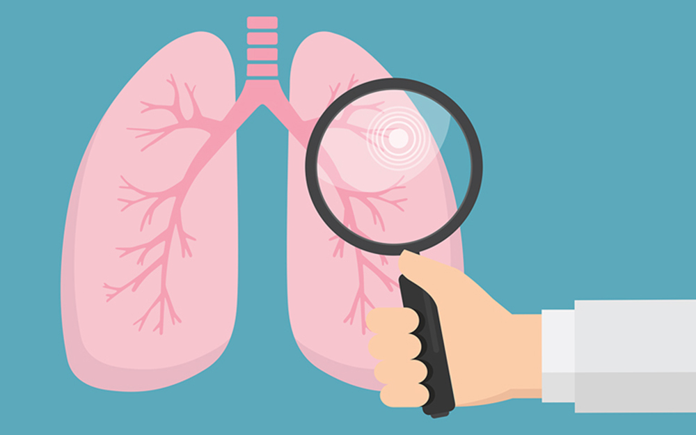Lung screening graphic.