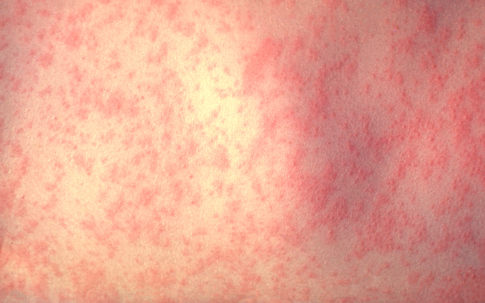 What You Need to Know About Measles teaser image