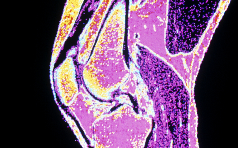 MRI, scan, tear, knee, ACL