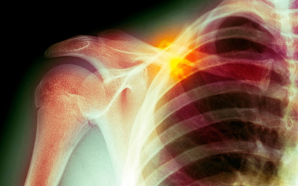 X-ray of a shoulder.