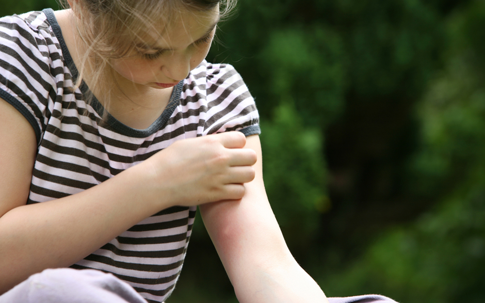 A young girl scratches a fresh bug bite on her arm.
