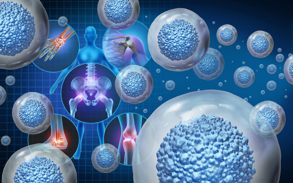 An illustration of novel orthopaedic stem cell therapies.