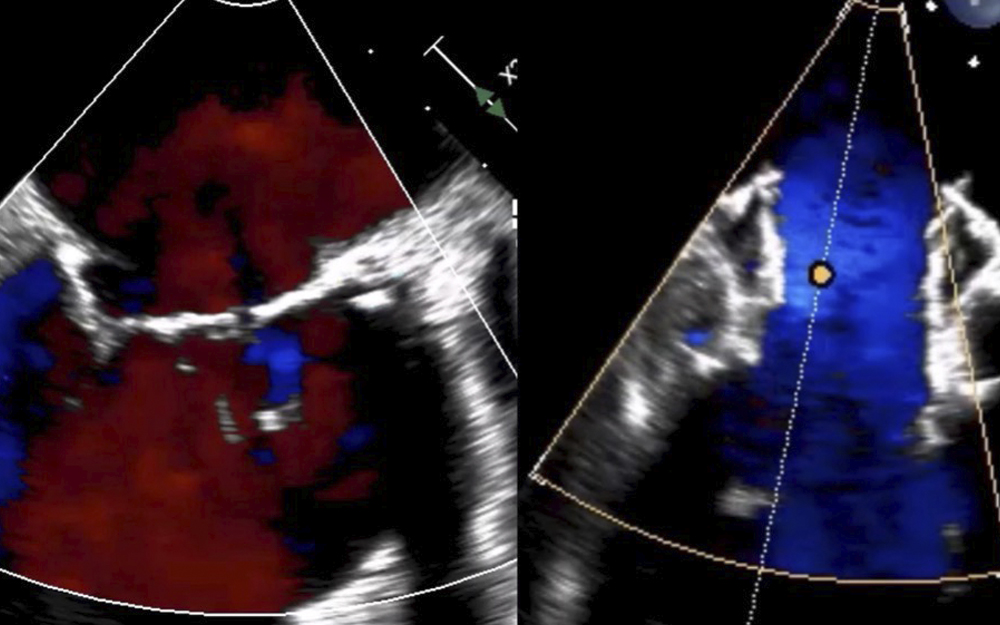 Echocardiography