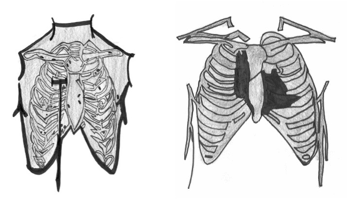 Figure 1. Left: A 2- to 3-inch incision for robotic and minimally invasive surgeries for aortic, mitral and tricuspid procedures. Right: A 2- to 3-inch incision for robotic coronary artery bypass surgeries.  