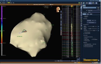 Video 1. Open-chest epicardial electrical mapping (OCEEM)—By touching the outer surface of the beating heart during open- heart surgery, an electrical mapping catheter is used to build a virtual heart with 3D software that shows areas of scar tissue (gray color) and healthy tissue (purple color), with other colors representing a mixture of scar and healthy in between. Scar tissue is targeted for catheter ablation.
