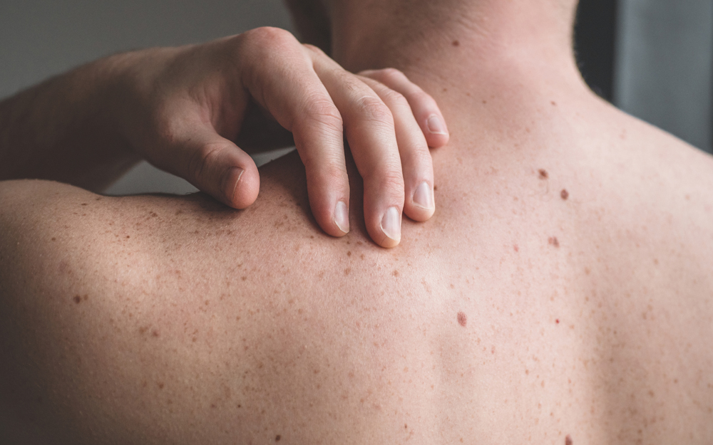 A patient gesturing to possible skin cancer lesions on his back.