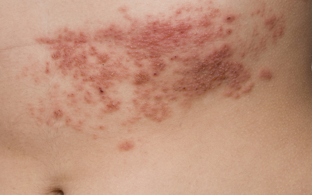 Shingles on the stomach area.