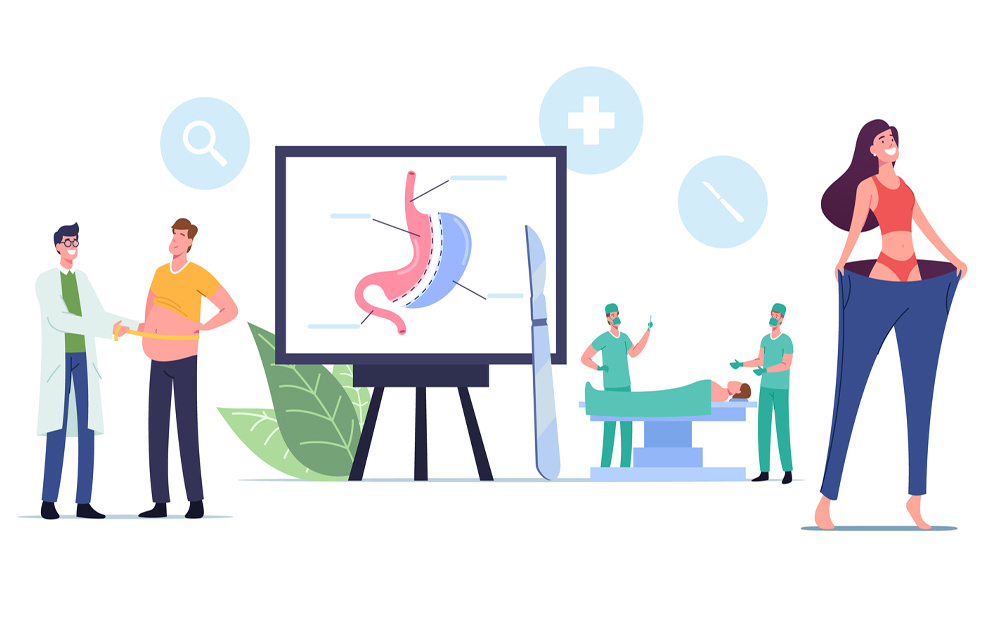 An illustration of the steps of bariatric surgery.