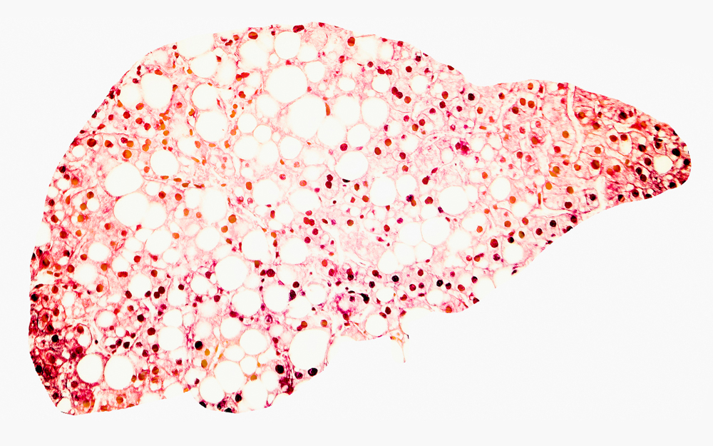 An illustration of Nonalcoholic steatohepatitis (NASH), an advanced form of nonalcoholic fatty liver disease.