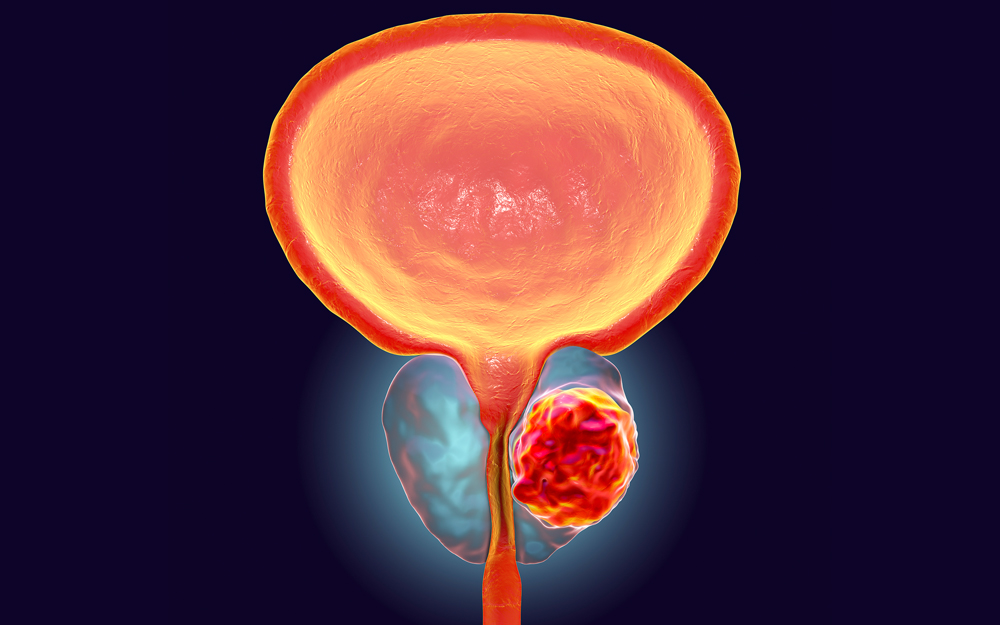 Prostate tumor medical illustration.