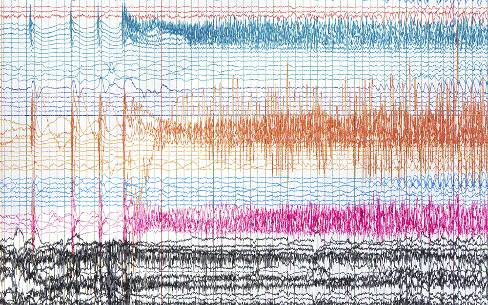 Brain waves during a seizure