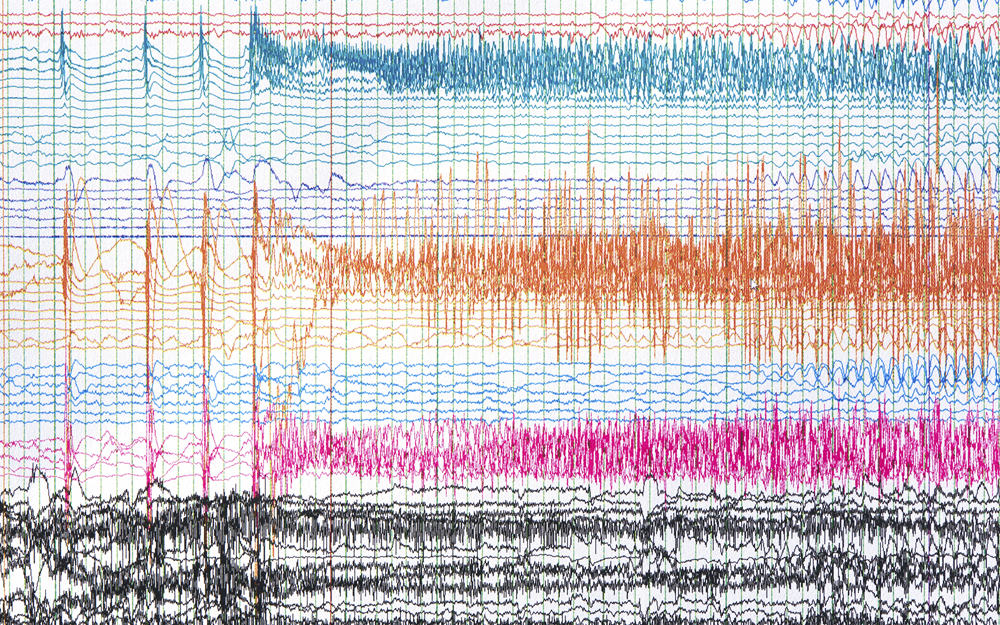 Epilepsy Brain Waves