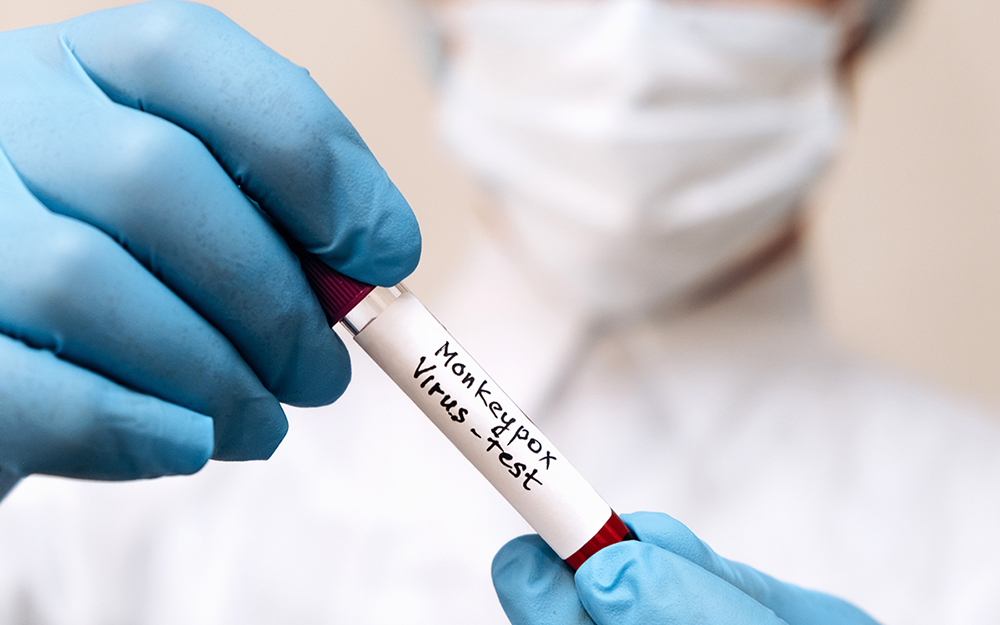 A medical worker holds a test tube with Monkeypox virus infected blood sample in his hands.