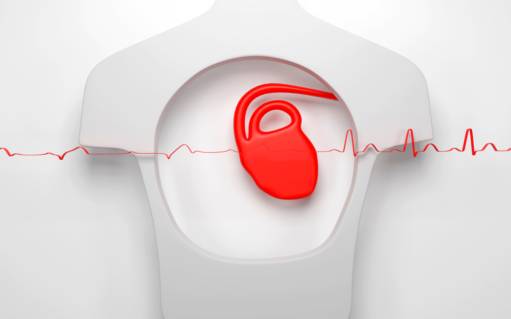 An illustration representing the abnormal heart beat of atrial fibrillation.