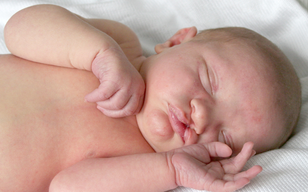 A young baby with a cleft pallet and cleft lip.