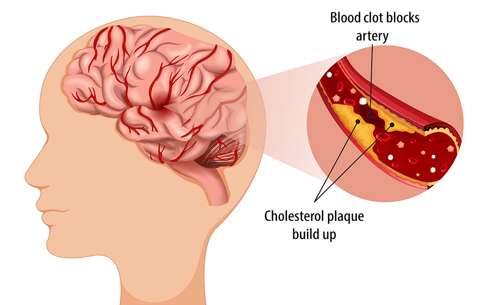 Atherosclerosis stroke graphic