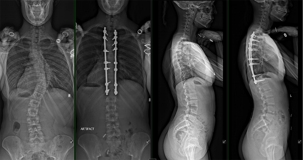 Milan Brahney's X-rays before and after surgery.