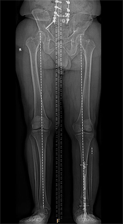 X-ray of Guy Natale's legs post-surgery.