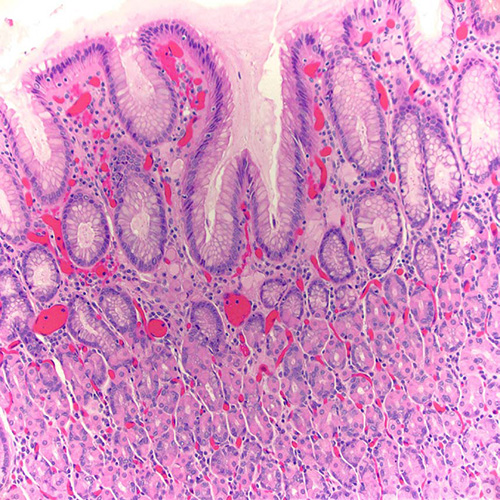 Pathology, Cedars-Sinai, Cancer,  Signet ring gastric adenocarcinoma, diffuse type