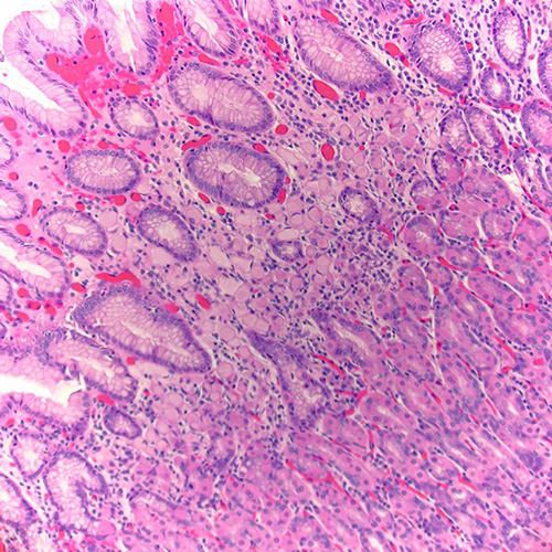 Pathology, Cedars-Sinai, Signet ring gastric adenocarcinoma, diffuse type
