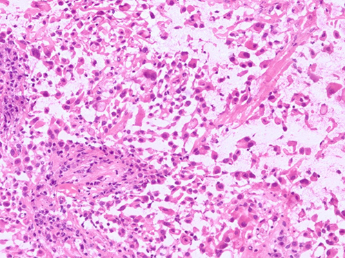 Extensively necrotic pleomorphic and epithelioid malignancy