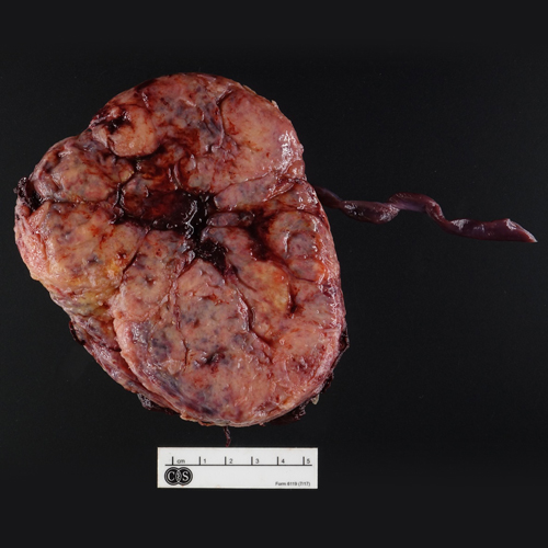 Gross Photo, Maternal Surface, Cedars-Sinai, pathology