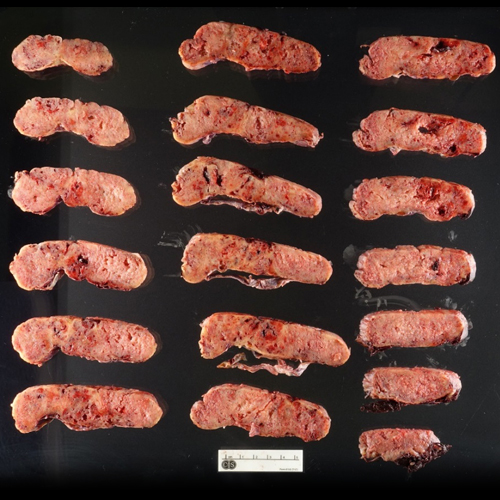 Gross Photo, Cross Section, Cedars-Sinai, pathology