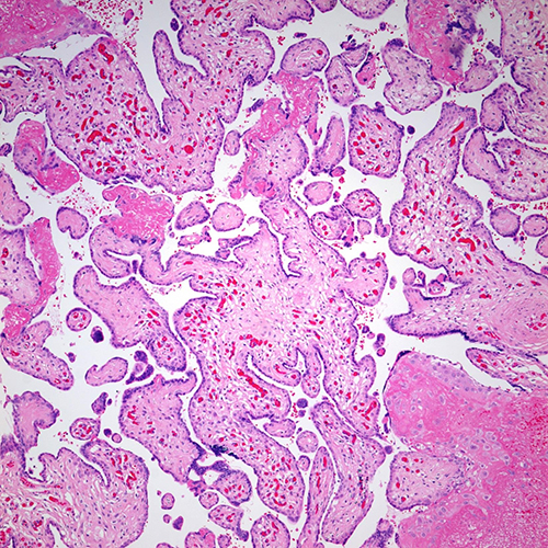 H&E, 10x. Terminal villi showing enlargement and increased numbers of capillaries.