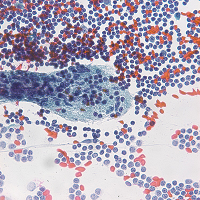 Cyst fluid cytology