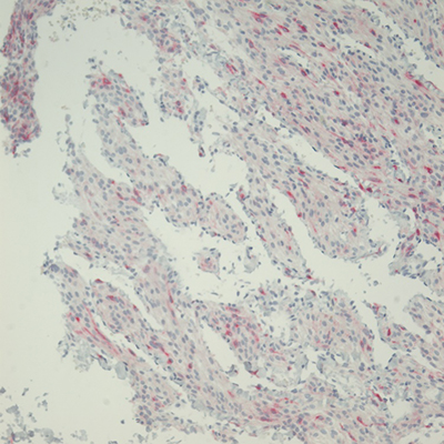 Spindled to epithelioid nuclear shapes, H&E, 60x