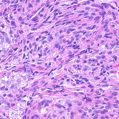 Spindled to epithelioid nuclear shapes, H&E, 60x