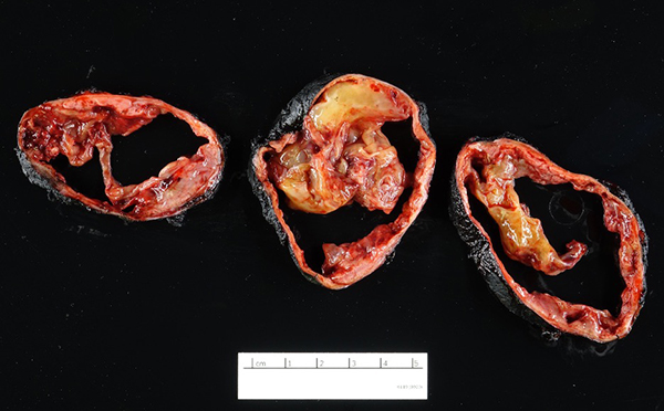A sectioned mass revealing cystic degeneration