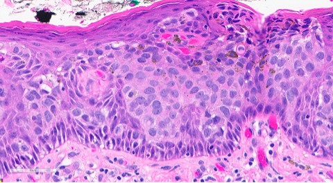 Figure 2. Section from the right vulva. The epidermis is composed of nests of tumor cells with large, vesicular nuclei with prominent nucleoli and abundant pale, eosinophilic cytoplasm. There are also intracytoplasmic vacuoles and dark pigment.