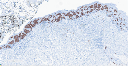 Figure 4. Immunohistochemistry. CK7, a membranous-cytoplasmic stain showing diffuse positivity in a nest-like pattern.