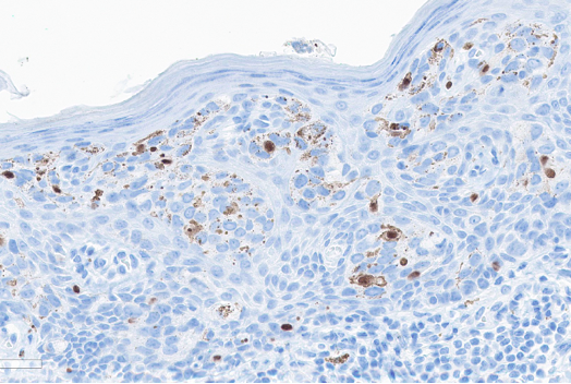 Figure 6. Immunohistochemistry. SOX10, a nuclear stain, was interpreted as negative in the cells of interest. The stain does highlight benign melanocytes.