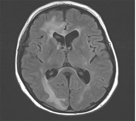 Figure 1. Magnetic resonance imaging (MRI). Sagittal view of edematous lesions representing metastatic carcinoma in the right frontal and occipital regions