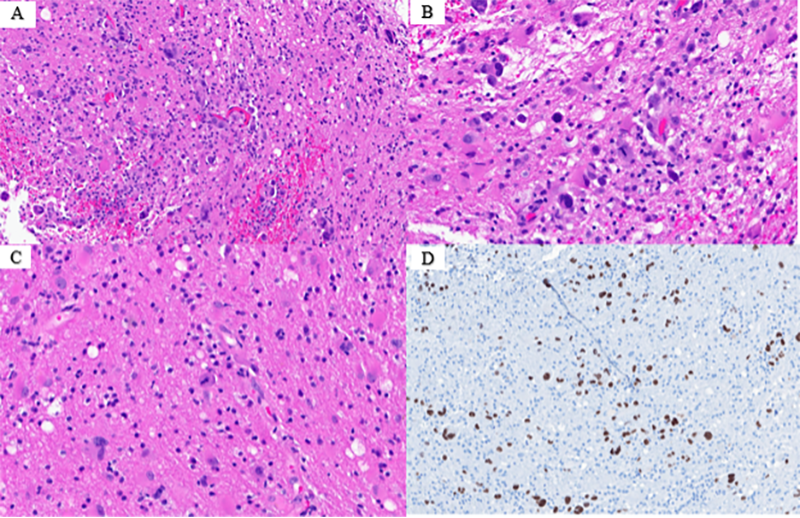Figure 2. Metastatic primary non-small cell lung carcinoma. A. Single cell infiltration of tumor cells within the white matter and cortex of the brain (4X) B. Single cell infiltration of tumor cells within the white matter and cortex of the brain (10X) C. Single cell infiltration of tumor cells 