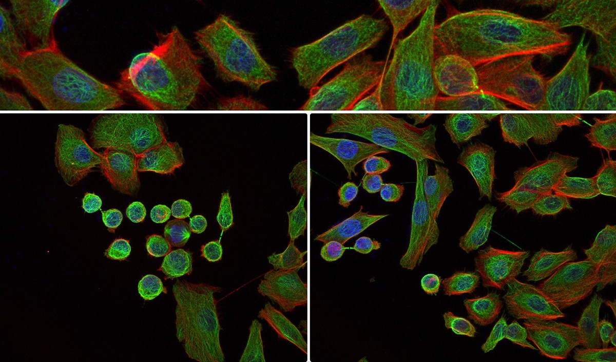 The image shows fluorescent staining of the cytoskeleton within metastatic prostate cancer cells. The nuclei of the cells are stained with DAPI (blue), the microtubules glow (green) with AlexaFluor488 and the F-actin filaments are stained bright (red) with AlexaFluor555. The scientific relevance is that we can see dynamic changes in the cytoskeleton when the cells divide (lower left), compared to their normal adherent state (upper & lower right). Cytoskeletal dynamics affect the response of prostate cancer cells to treatment. 3rd place winner, Sara Pollan is studying Metastatic Cancer in the Department of Biomedical Sciences. Sara is a Postdoctoral Scientist in Dr. Beatrice Knudsen's Lab.