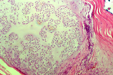 Chondrosarcoma sample