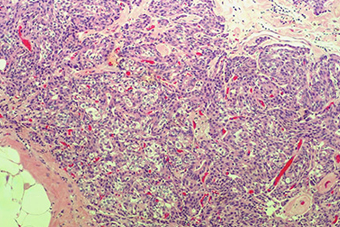 Breast pathology slide