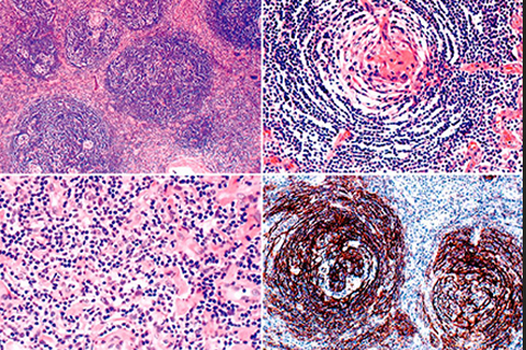 lymph node hyperplasia and angiofollicular lymph node hyperplasia